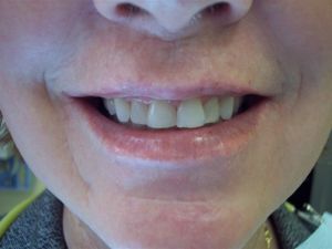 before photo of a person's mouth with smile and teeth on display