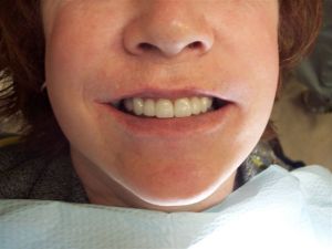 after photo of person's mouth with a smile and teeth on display