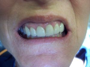 before procedure photo of teeth