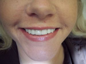 after procedure photo of teeth