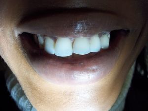before procedure photo of mouth and teeth