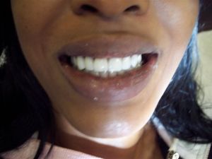 after procedure photo of mouth and teeth