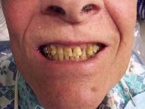 before procedure photo of mouth with teeth on display