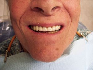 after treatment photo of mouth with teeth on display