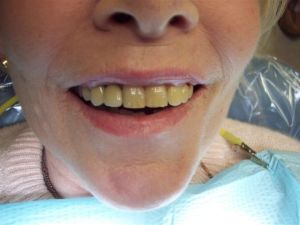 before treatment photo of teeth