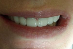 after treatment photo of teeth